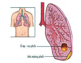 Cảnh báo áp xe phổi ở trẻ em