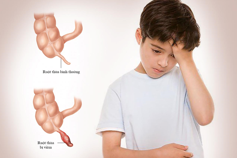 Cảnh báo tình trạng viêm ruột thừa đến muộn ở trẻ em.
