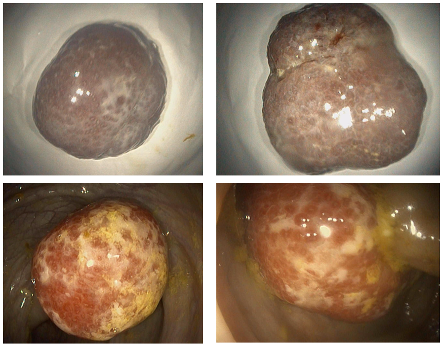 Thủ thuật nhanh gọn – xử lý polyp trong lòng đại tràng rất lớn gây lồng ruột cho trẻ