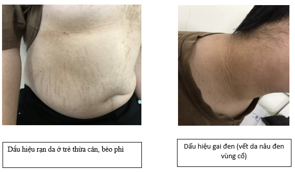 Thừa cân, béo phì ở trẻ em, mối lo ngại thời đại