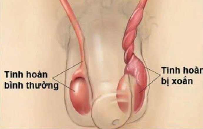 Cảnh báo tình trạng xoắn tinh hoàn ở trẻ em: không thể chủ quan