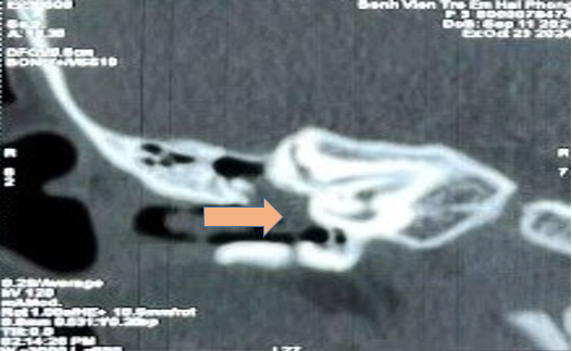 Cholesteatoma tai giữa ở trẻ em – bệnh lý nguy hiểm dễ bị bỏ sót