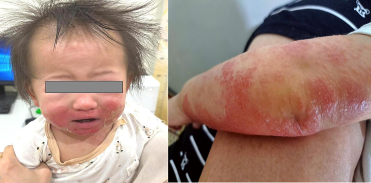 Cảnh giác viêm da cơ địa mùa hanh khô